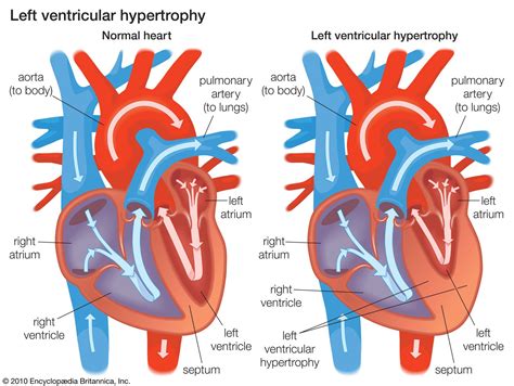 Right Ventricular Dysfunction and the “D”.